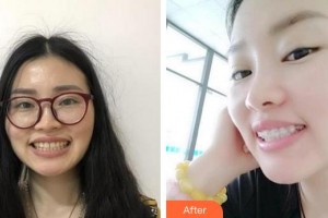 漳州衛(wèi)生職業(yè)學(xué)院附屬口腔醫(yī)院劉華英整形價格表附牙齒金屬矯正案例展示