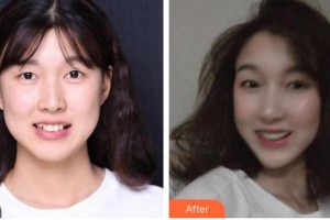 漳州南健口腔門診部劉明廣整形價格表附隱形托槽矯正案例展示