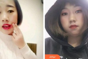 漳州柏思婭醫(yī)療美容門診部劉躍輝整形價格表附隱形矯正案例展示