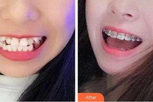 漳州南健口腔門診部呂彩華整形價格表附全齒金屬矯正案例展示