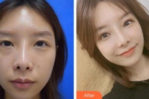 漳州柏思婭醫(yī)療美容門診部李攀整形價格表附雙眼皮修復(fù)案例案例展示