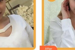 南平時光醫(yī)療美容門診部趙宏宇整形價格表附自體脂肪豐胸案例展示