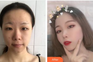 南平時光醫(yī)療美容門診部廖振浩整形價格表附埋線提升案例展示