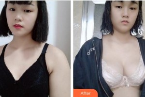 南平時光醫(yī)療美容門診部侯銳樺整形價格表附隆胸案例展示