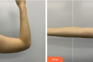 南平時光醫(yī)療美容門診部金永奎整形價格表附手臂吸脂案例展示