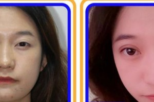 南平華廈眼科醫(yī)院林巧妹整形價格表附眼部綜合案例展示