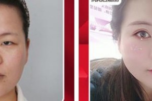 南平華廈眼科醫(yī)院胡甫密整形價格表附切開雙眼皮案例展示