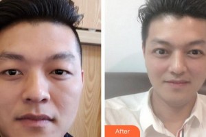 南平武夷厚生眼科醫(yī)院葉荷花整形價格表附眼部整形案例展示