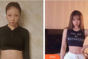 南平市第一醫(yī)院燒傷整形科黃道強整形價格表附疤痕案例展示