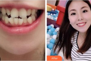 龍巖華美醫(yī)療美容醫(yī)院林永桂整形價格表附金屬托槽矯正案例展示