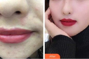 龍巖華美醫(yī)療美容醫(yī)院劉春鳳整形價格表附激光美膚嫩膚案例展示