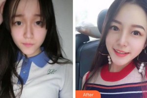 龍巖市第一醫(yī)院燒傷整形醫(yī)療美容科溫裕慶整形價格表附眼部手術(shù)案例展示