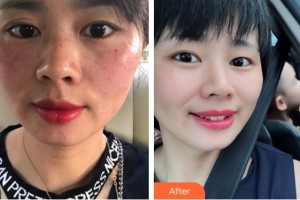 龍巖博愛醫(yī)院整形美容中心林珍娘整形價格表附超激光美膚案例展示