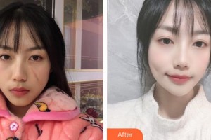 龍巖人民醫(yī)院燒傷整形科林啟雄整形價格表附疤痕案例展示