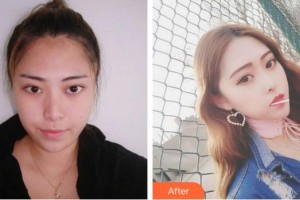 寧德442醫(yī)院整形美容中心趙巖整形價格表附可愛多變美日記案例展示