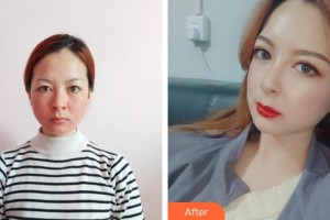 寧德東韓整形美容醫(yī)院聶艷武整形價格表附熱瑪吉案例展示