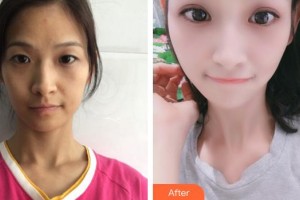 寧德眼科醫(yī)院林寬添整形價格表附眼部綜合案例展示