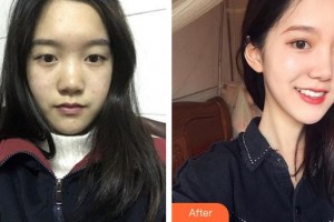 寧德眼科醫(yī)院李小霞整形價格表附雙眼皮+開眼角+提肌案例展示