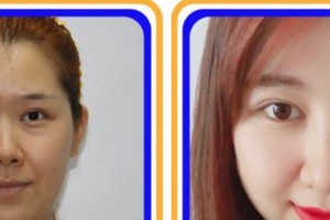 寧德眼科醫(yī)院范圣麗整形價格表附眼部綜合案例展示