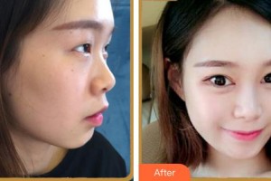 安徽立新醫(yī)學(xué)美容門診部黃海彬整形價(jià)格表附眼部多項(xiàng)案例展示