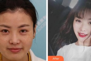 安徽立新醫(yī)學美容門診部楊義整形價格表附激光美膚激光案例展示