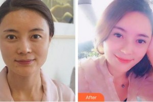 安徽立新醫(yī)學(xué)美容門診部徐商熏整形價格表附半年的韓式全切雙眼皮案例展示