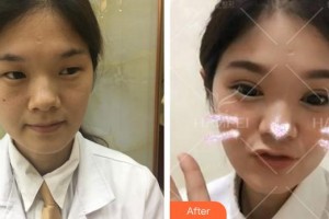 安徽立新醫(yī)學(xué)美容門診部李鐘輝整形價格表附雙眼皮案例展示