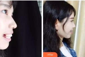 安徽韓美整形美容醫(yī)院姜山整形價格表附齙牙小仙女案例展示
