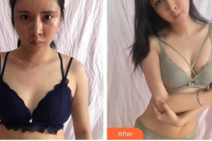 安徽醫(yī)科大學(xué)第二附屬醫(yī)院整形美容中心曹東升整形價格表附隆胸案例展示