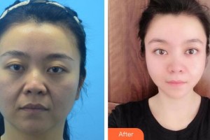 安徽立新醫(yī)學(xué)美容門診部楊鵬整形價格表附埋線提升案例展示