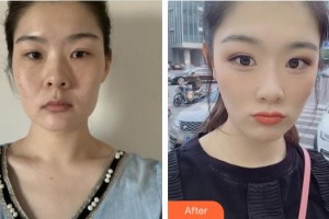 安徽醫(yī)科大學(xué)第二附屬醫(yī)院整形美容中心謝娟整形價格表附面部年輕化案例展示