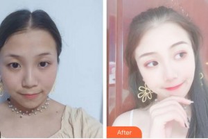 安徽醫(yī)科大學(xué)第二附屬醫(yī)院整形美容中心丁浩整形價格表附埋線提升案例展示