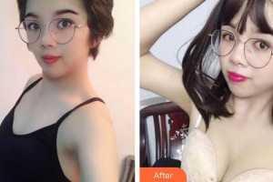 安徽省立醫(yī)院整形燒傷外科王明剛整形價格表附胸部案例展示