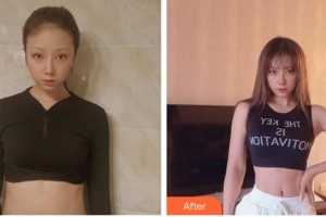 安徽省立醫(yī)院整形燒傷外科褚燕軍整形價格表附疤痕案例展示