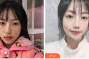 安徽醫(yī)科大學(xué)第一附屬醫(yī)院整形美容中心趙宇整形價格表附祛疤案例展示