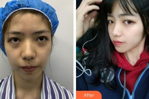 安徽立新醫(yī)學(xué)美容門診部江菊整形價格表附面部埋線提升案例展示