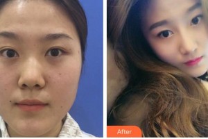 安徽韓美整形美容醫(yī)院金升俊整形價格表附隆鼻案例展示