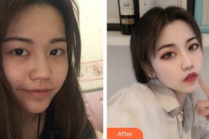 安徽韓美整形美容醫(yī)院葉伊琳整形價格表附激光美膚激光美白案例展示