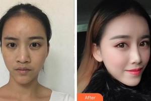 安徽醫(yī)科大學(xué)第一附屬醫(yī)院整形美容中心寧金龍整形價格表附鼻部手術(shù)案例展示