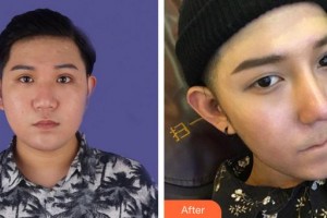 安徽醫(yī)科大學(xué)第一附屬醫(yī)院整形美容中心李小靜整形價格表附鼻部整形案例展示