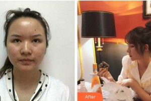 安徽醫(yī)科大學(xué)第一附屬醫(yī)院整形美容中心高學(xué)宏整形價格表附鼻部手術(shù)日記案例展示