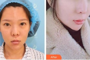 安徽醫(yī)科大學(xué)第一附屬醫(yī)院整形美容中心張林整形價格表附網(wǎng)紅鼻部手術(shù)案例展示