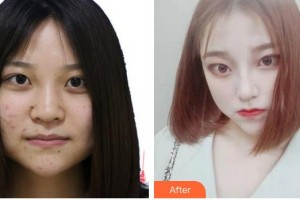 安徽醫(yī)科大學(xué)第一附屬醫(yī)院整形美容中心朱飛整形價格表附鼻部手術(shù)案例展示