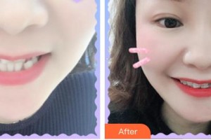 安徽長征微創(chuàng)外科醫(yī)院整形美容科張智整形價格表附牙齒矯正案例展示