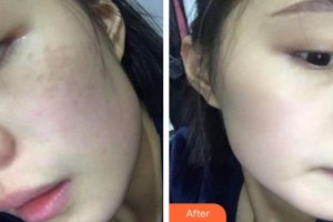 安徽長征微創(chuàng)外科醫(yī)院整形美容科何燕整形價格表附超激光美膚案例展示