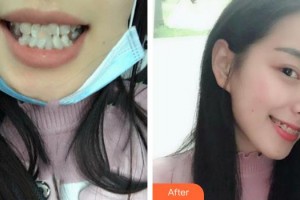 安徽韓美整形美容醫(yī)院相道舉整形價(jià)格表附牙齒陶瓷矯正案例展示