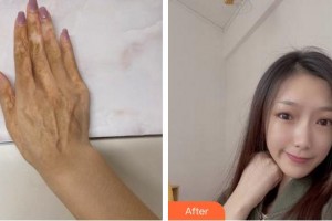 武警安徽總隊(duì)醫(yī)院皮膚美容科袁鋒整形價(jià)格表附手術(shù)祛疤案例展示