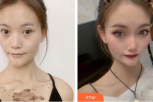 武警安徽總隊(duì)醫(yī)院皮膚美容科郭明亮整形價(jià)格表附祛疤案例展示