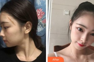 武警安徽總隊(duì)醫(yī)院皮膚美容科陳政利整形價(jià)格表附疤痕案例展示