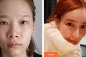 安徽韓美整形美容醫(yī)院劉冷整形價(jià)格表附隆鼻案例展示